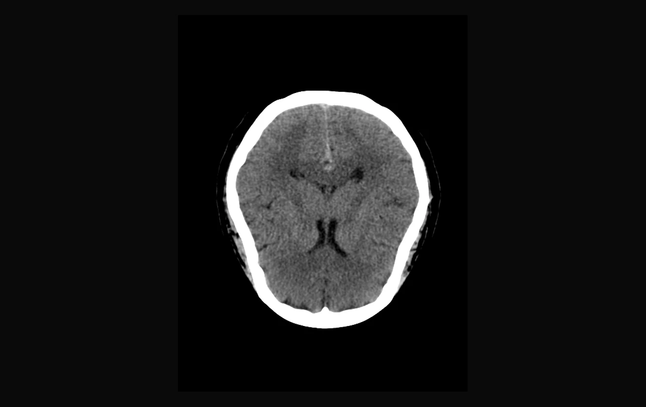 Lens viewer showing an axial clinical CT slice of a head with Hounsfield-unit windowing, z-slice scrubbing at 18 of 34, and 0.39 x 0.39 x 5.00 mm anisotropic voxel spacing.